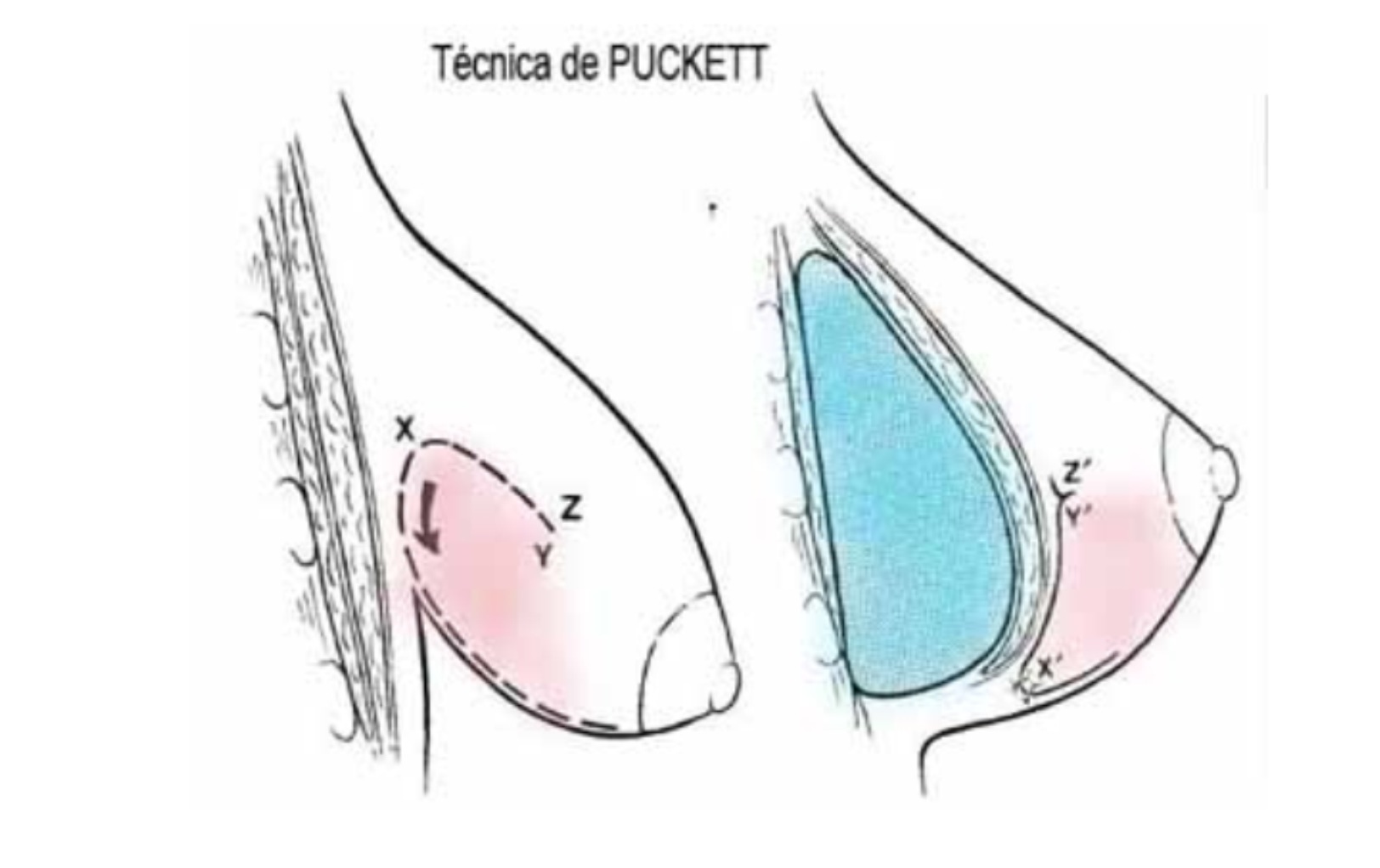тубулярная форма груди у женщин фото 106