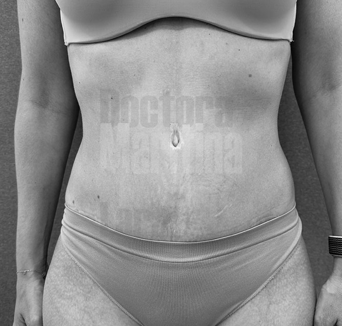 Liposucción de abdomen - Clínica cirujana plástica Dra. Martínez Lara