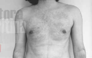 ginecomastia en un paciente con aumento del volumen mamario