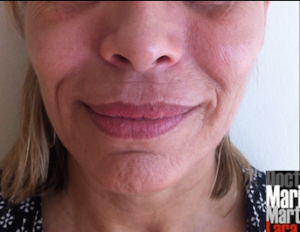 lipoestructura facial