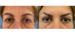 240118_Blefaroplastia