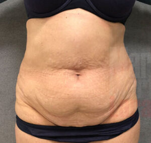 Abdominoplastia01_antes