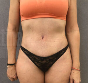 Abdominoplastia02_despues