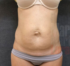 Abdominoplastia03_antes