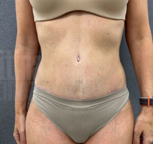 Abdominoplastia03_despues