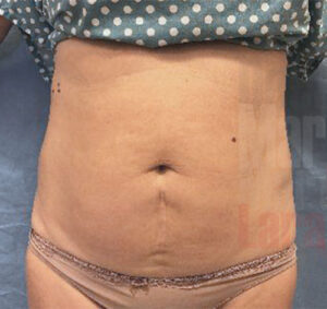 Abdominoplastia_02_antes