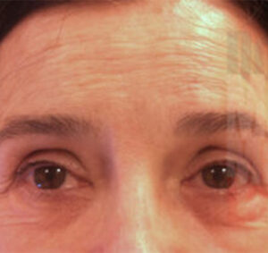 Blefaroplastia_01_antes