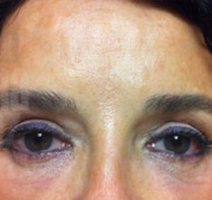 Blefaroplastia_01_despues