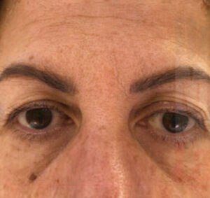 Blefaroplastia01_antes