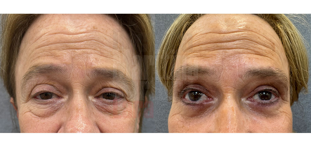 Blefaroplastia