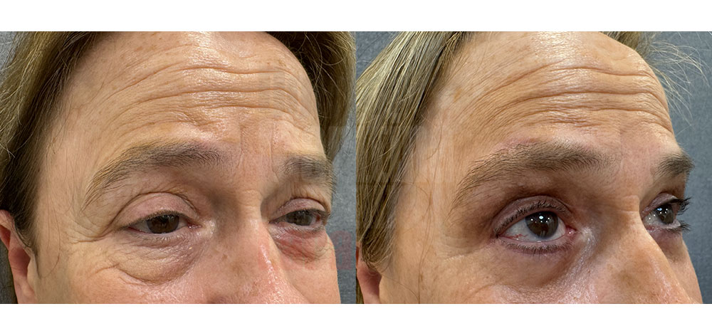 Blefaroplastia