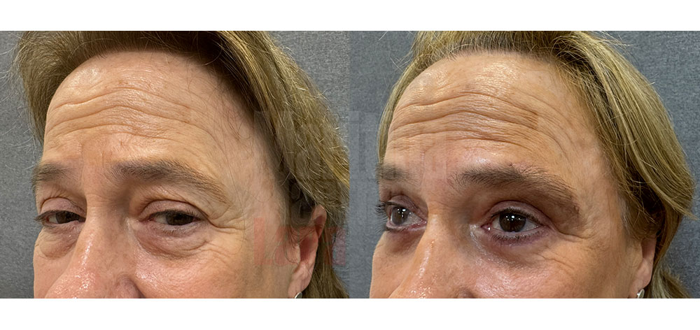 Blefaroplastia