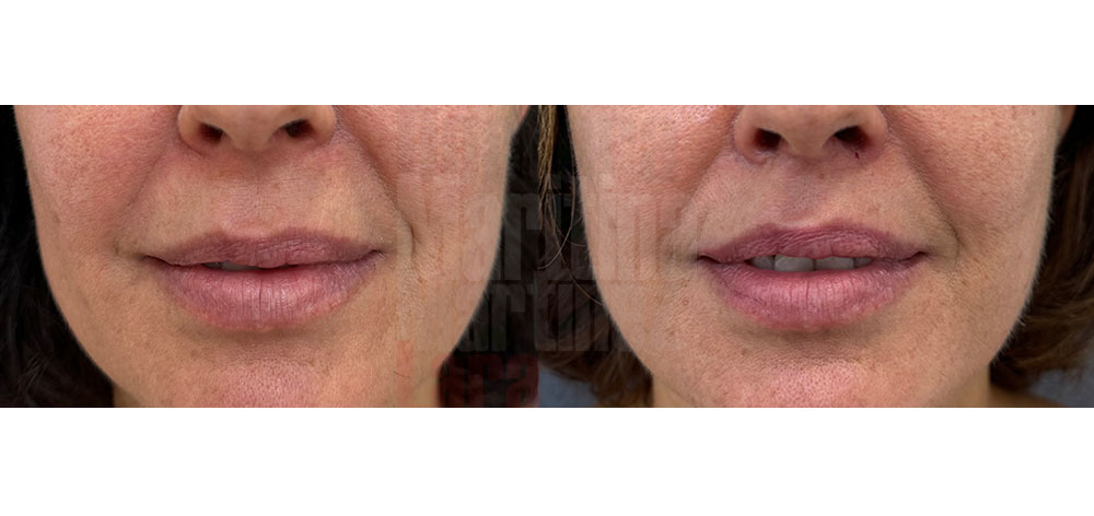 LipLift cirugía