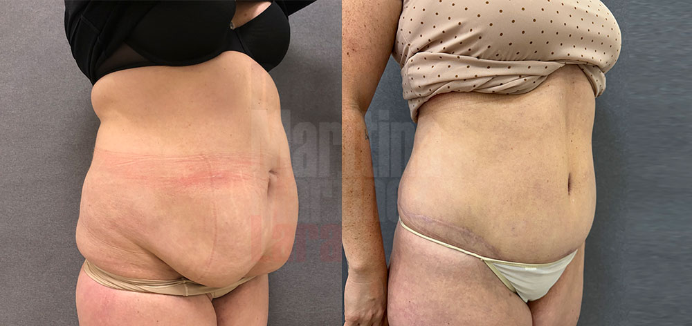 Abdominoplastia-liposucción 5