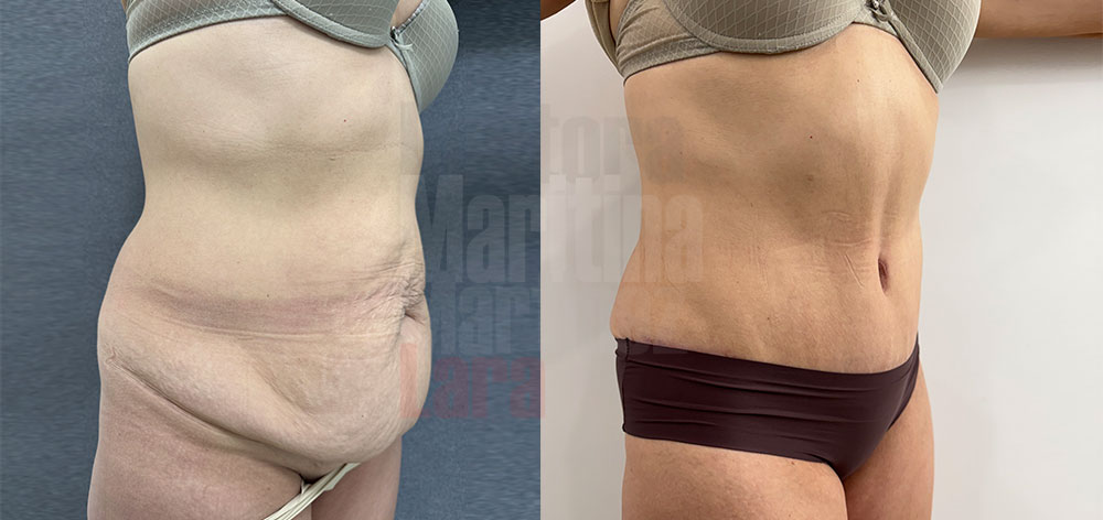 Abdominoplastia abdomen péndulo 5